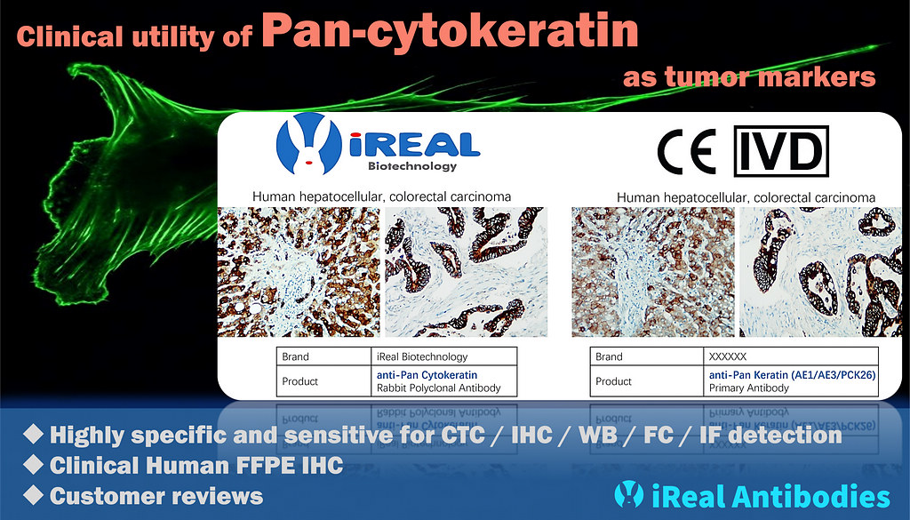 Clinical utility of Pan-cytokeratin antibody