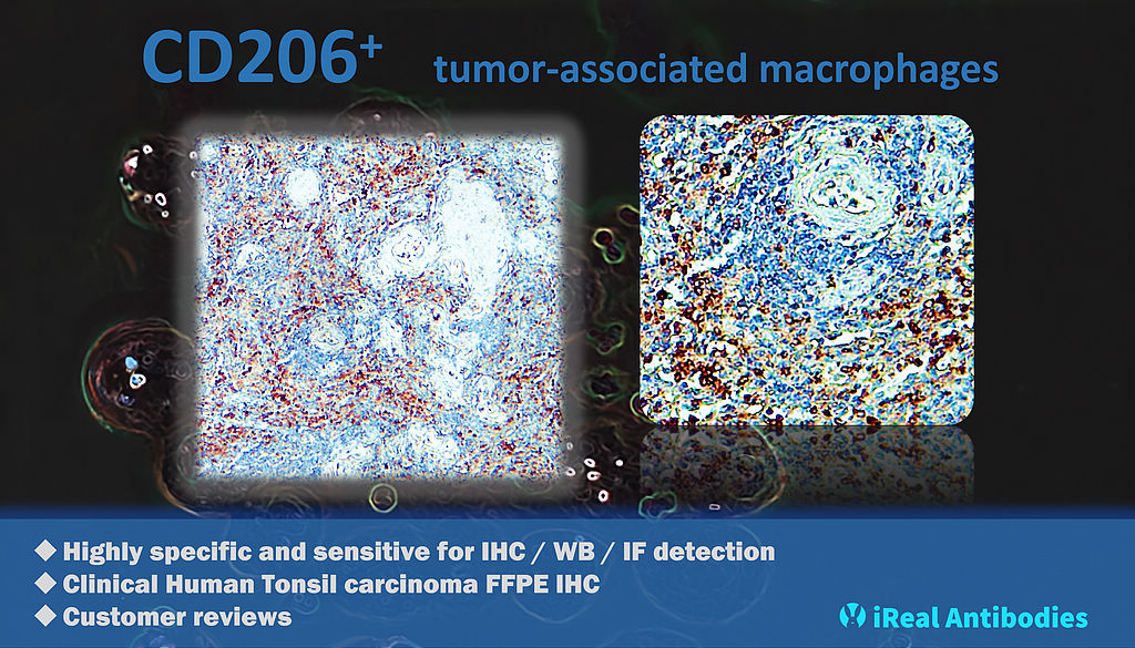 CD206+ tumor-associated macrophages