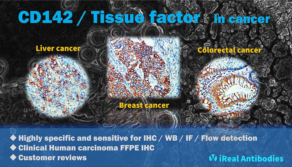 CD142 Tissue factor in cancer