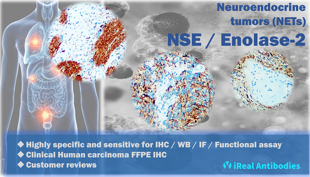 Neuroendocrine tumors (NETs) : NSE / Enolase-2