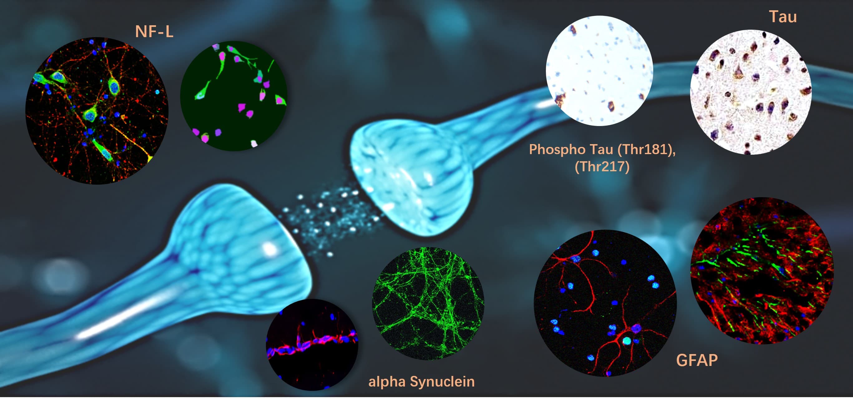 Neurodegenerative Alzheimer's disease (AD) marker