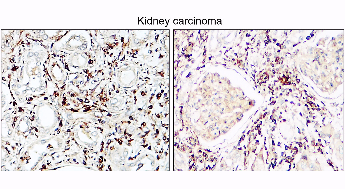 IR108-442 anti-VEGF antibody_Kidney carcinoma IHC image