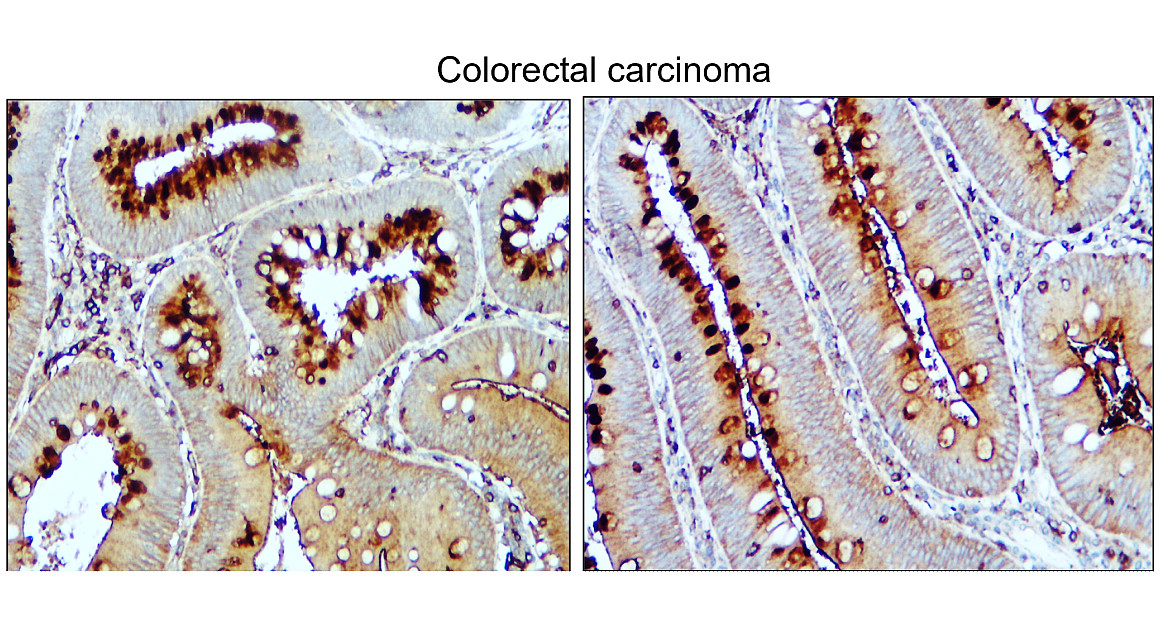 IR108-442 anti-VEGF antibody_Colorectal carcinoma IHC image