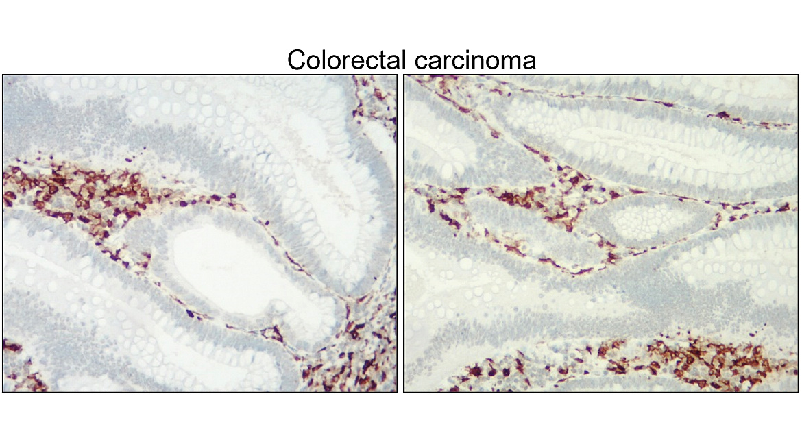 IR13-36 anti-Iba1/AIF1 antibody_Colorectal carcinoma IHC image