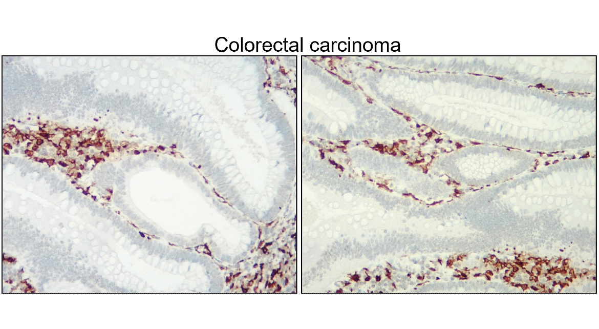 IR13-36 anti-Iba1/AIF1 antibody_Colorectal carcinoma IHC image IR13-36 anti-Iba1/AIF1 antibody_Colorectal carcinoma IHC image
