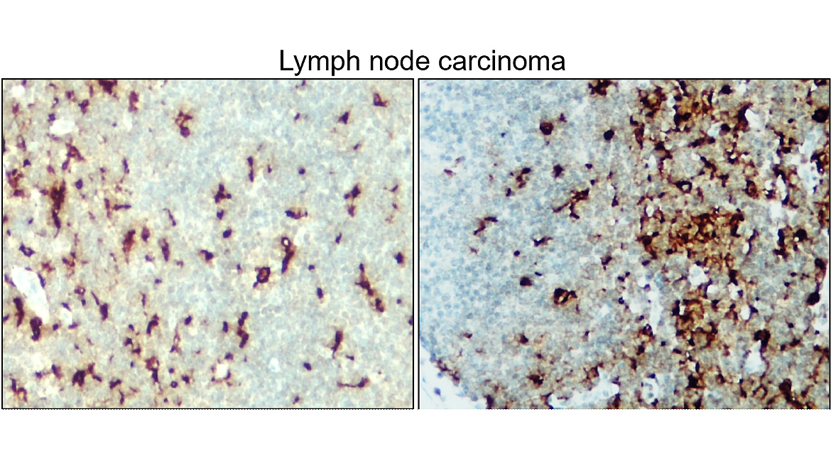 IR13-36 anti-Iba1/AIF1 antibody_Lymoph node carcinoma IHC image