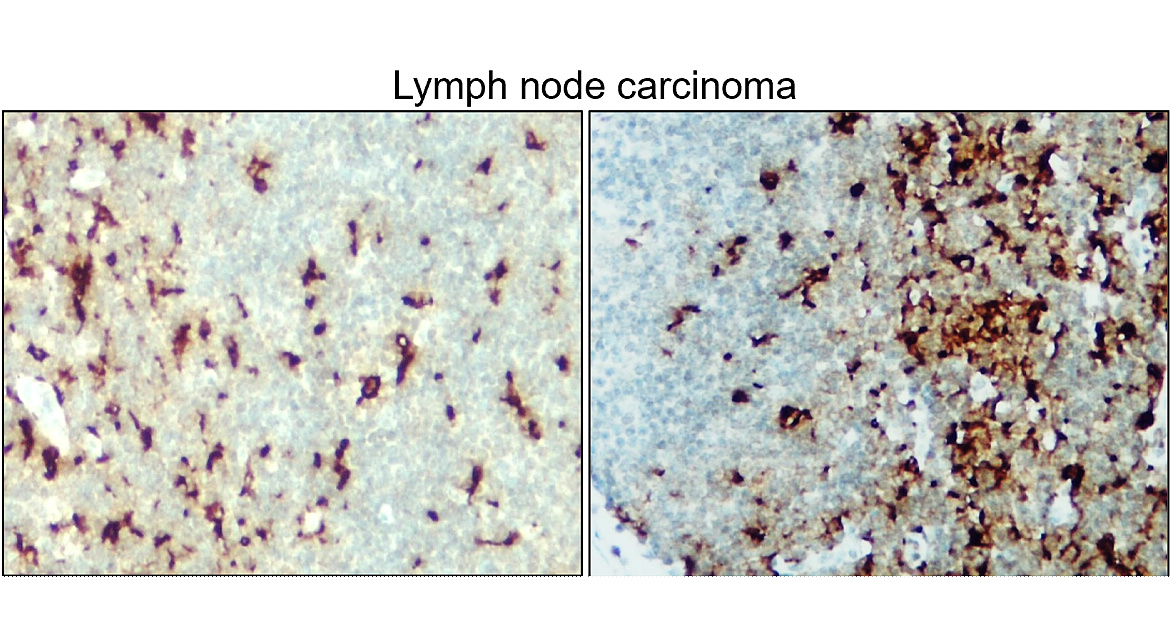 IR13-36 anti-Iba1/AIF1 antibody_Lymoph node carcinoma IHC image IR13-36 anti-Iba1/AIF1 antibody_Lymoph node carcinoma IHC image
