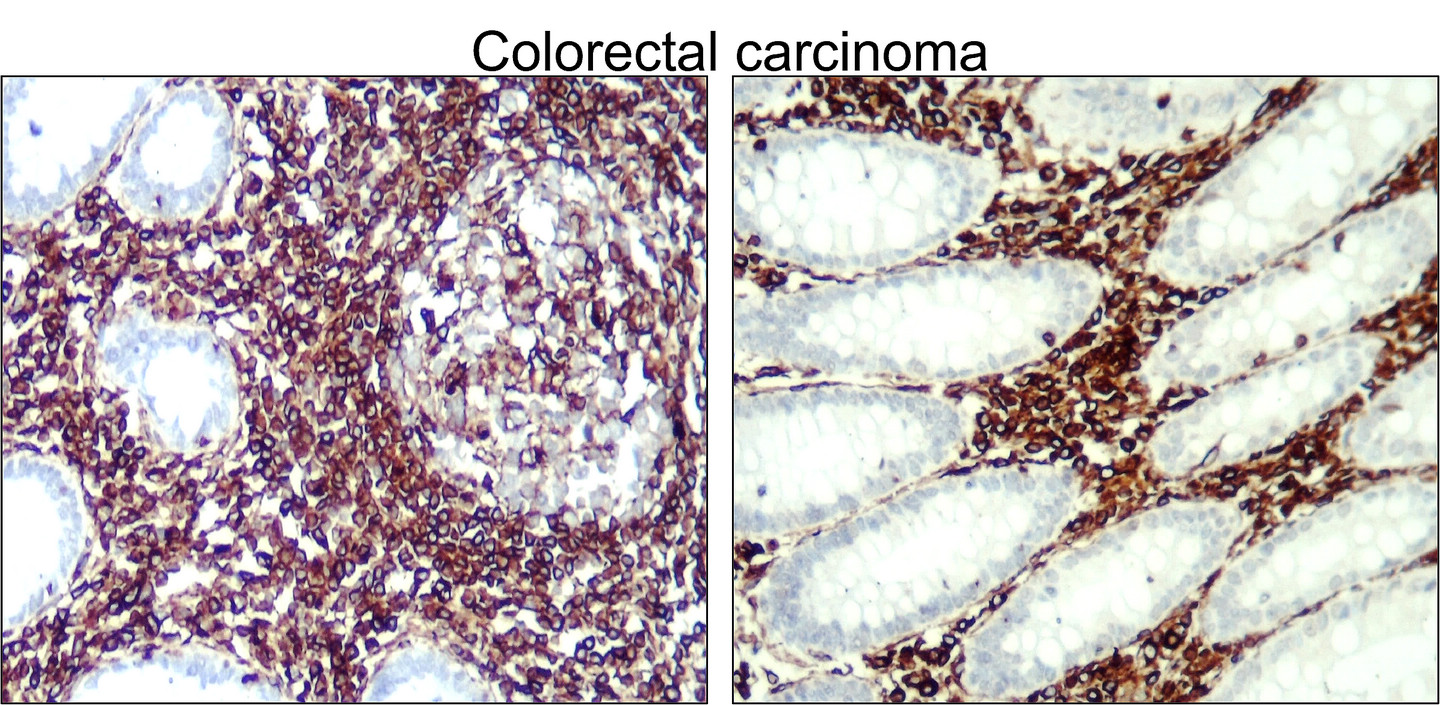 IR45-137 anti-Vimentin antibody_Colorectal carcinoma IHC image
