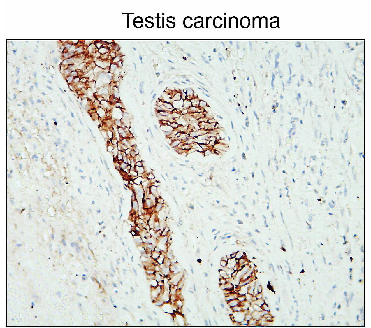IR46-143 anti- N cadherin antibody_Testis carcinoma IHC image