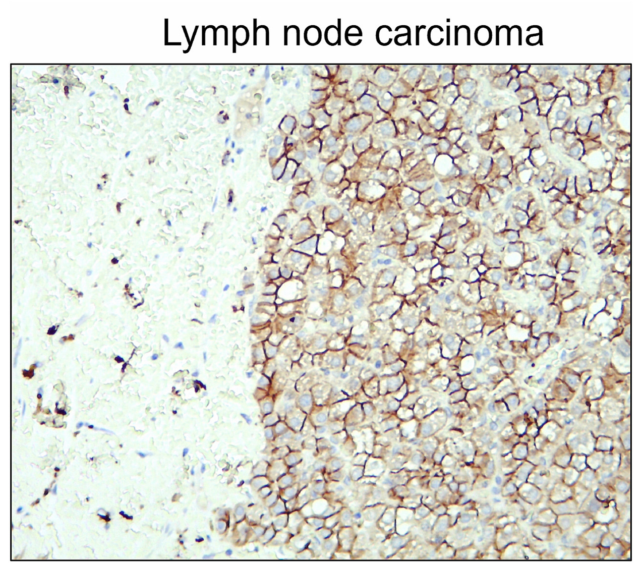 IR46-143 anti- N cadherin antibody_Lymph node carcinoma IHC image