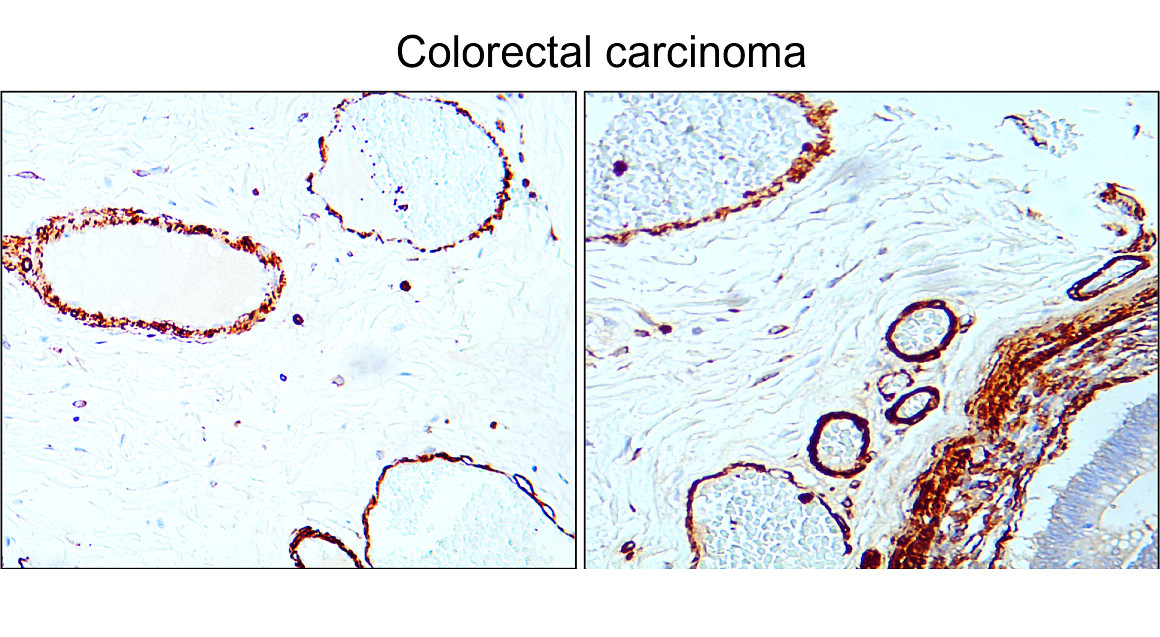 IR47-146 anti-α Smooth Muscle Actin antibody_Colorectal carcinoma IHC image