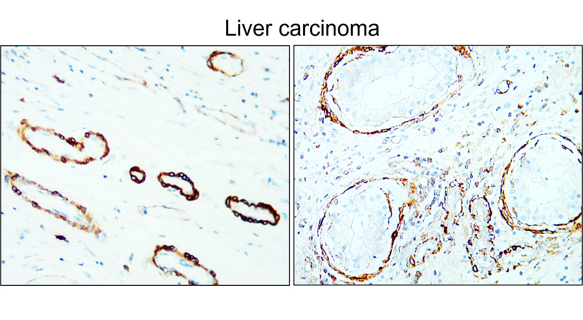 IR47-146 anti-α Smooth Muscle Actin antibody_Liver carcinoma IHC image