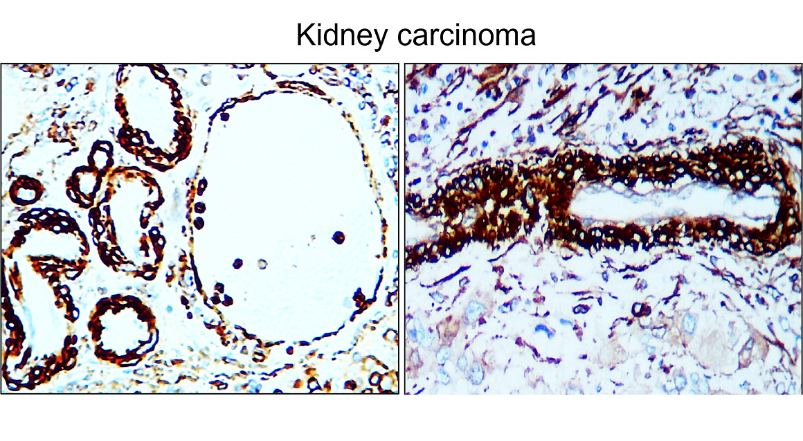 IR47-146 anti-α Smooth Muscle Actin antibody_Kidney carcinoma IHC image