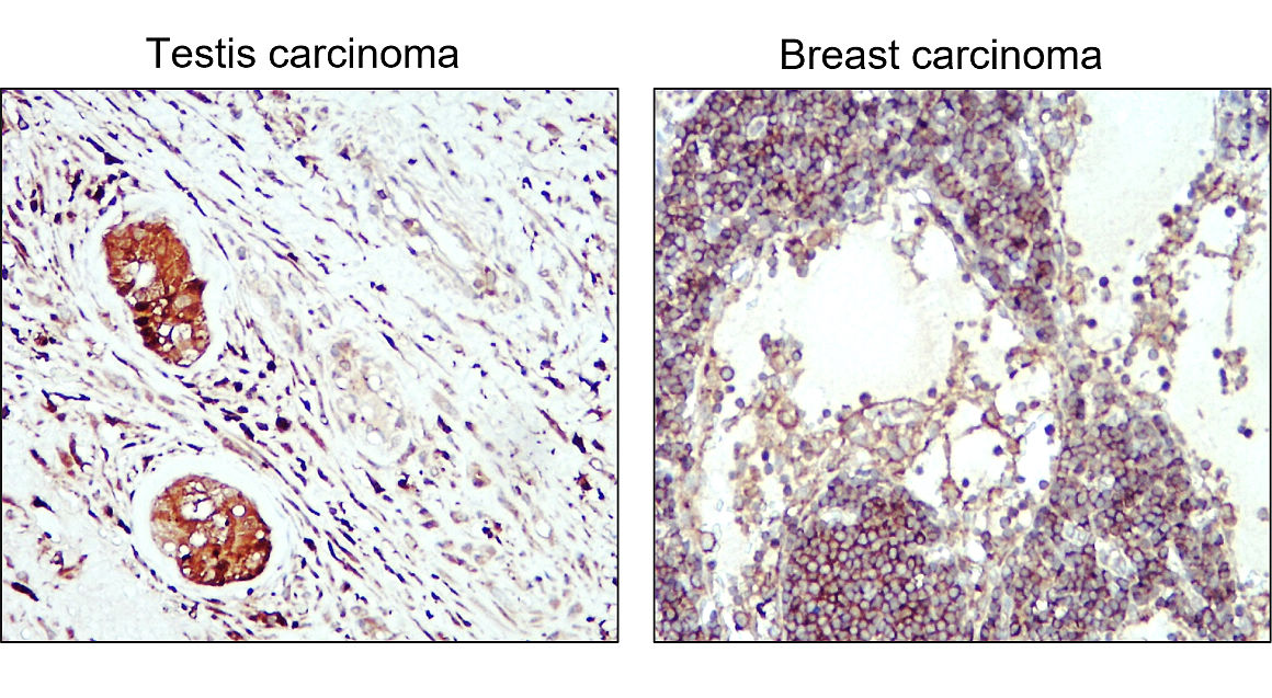 IR84-366 anti-LC3B antibody_Human testis and breast cancer tissue IHC image 