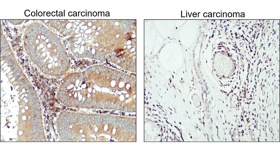 IR84-366 anti-LC3B antibody_ Human colorental and liver cancer tissue IHC image