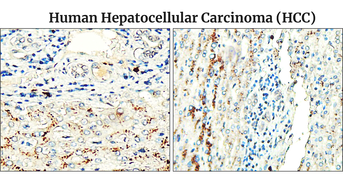 IR48-138 anti-Fibronectin antibody _Human Hepatocellular Carcinoma (HCC) IHC image