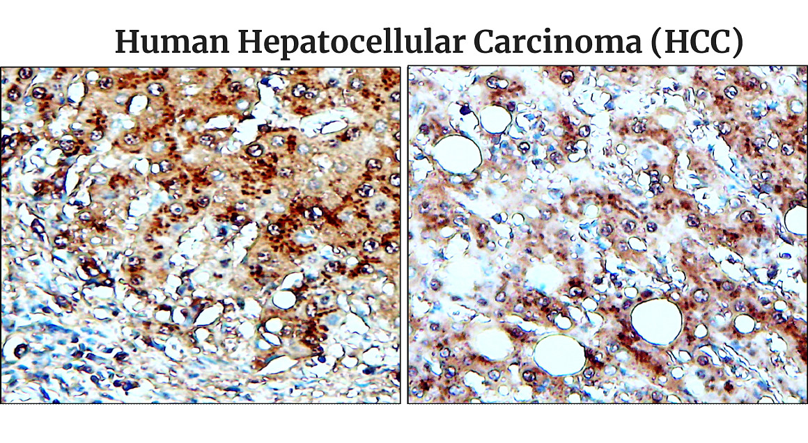 IR48-138 anti-Fibronectin antibody _Human Hepatocellular Carcinoma (HCC) IHC image	