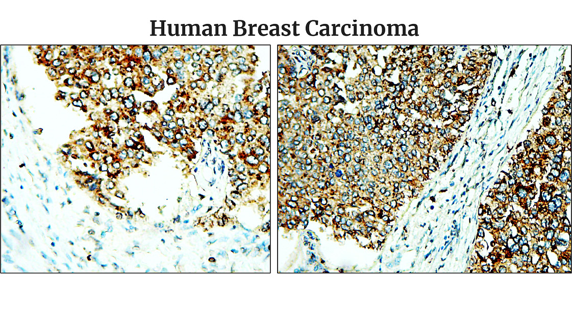 IR48-138 anti-Fibronectin antibody_Human Breast Carcinoma IHC image