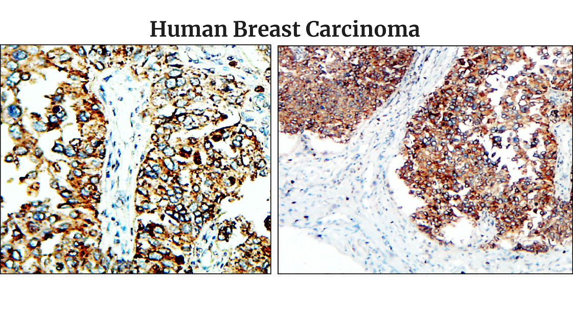 IR48-138 anti-Fibronectin antibody_Human Breast Carcinoma IHC image
