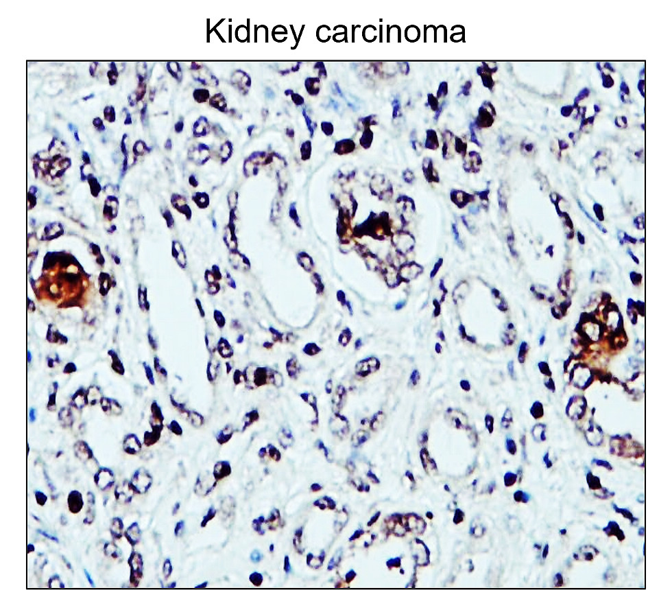 IR48-147 anti-Fibronectin antibody_Kidney carcinoma IHC image IR48-147 anti-Fibronectin antibody_Kidney carcinoma IHC image