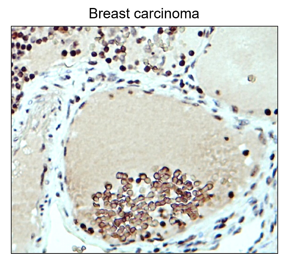 IR48-147 anti-Fibronectin antibody_Breast carcinoma IHC image IR48-147 anti-Fibronectin antibody_Breast carcinoma IHC image
