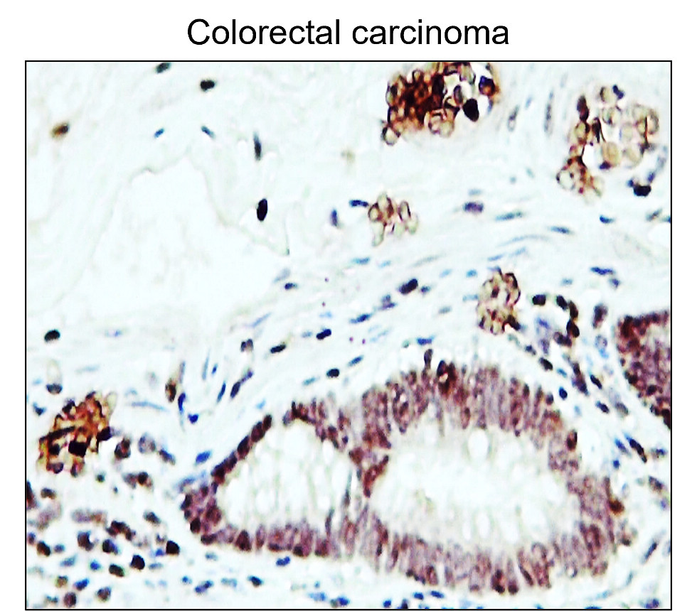 IR48-147 anti-Fibronectin antibody_Colorectal carcinoma IHC image IR48-147 anti-Fibronectin antibody_Colorectal carcinoma IHC image