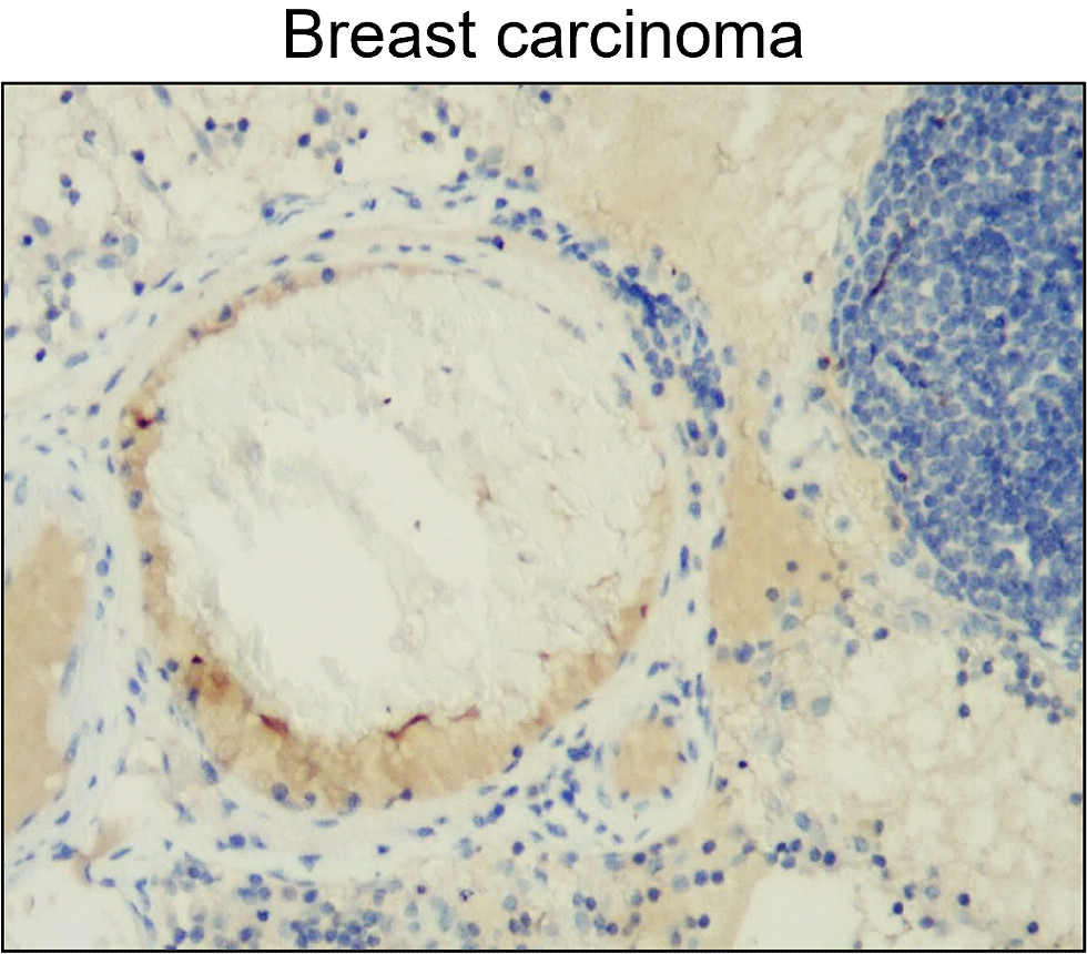 IR67-227 anti- MMP2 antibody_Breast carcinoma IHC image