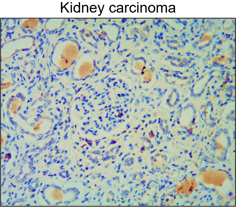 IR67-227 anti- MMP2 antibody_Kidney carcinoma IHC image