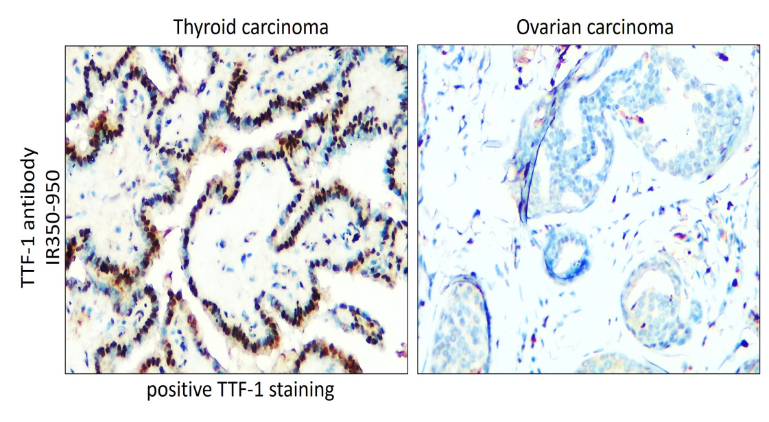 IR350-950 anti-Thyroid Transcription Factor 1 antibody IHC image IR350-950 anti-Thyroid Transcription Factor 1 antibody IHC image