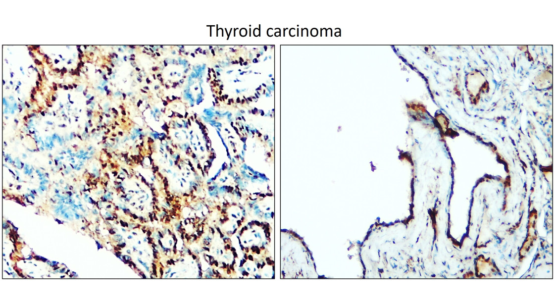 IR350-950 anti-Thyroid Transcription Factor 1 antibody IHC image IR350-950 anti-Thyroid Transcription Factor 1 antibody IHC image