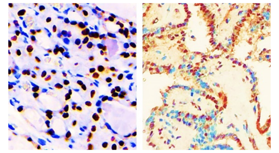 IR350-950 anti-Thyroid Transcription Factor 1 antibody IHC image IR350-950 anti-Thyroid Transcription Factor 1 antibody IHC image