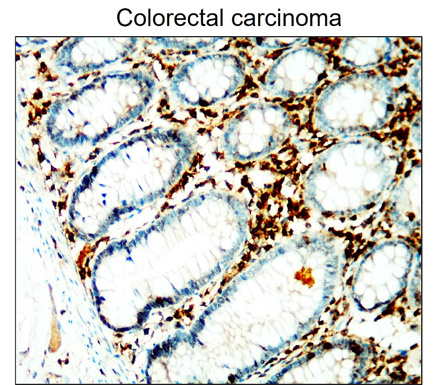 IR77-263 anti-CD45 antibody_Colorectal carcinoma IHC image