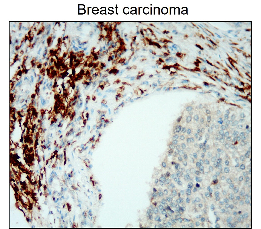 IR77-263 anti-CD45 antibody_Breast carcinoma IHC image