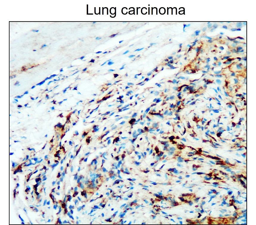 IR77-263 anti-CD45 antibody_Lung carcinoma IHC image