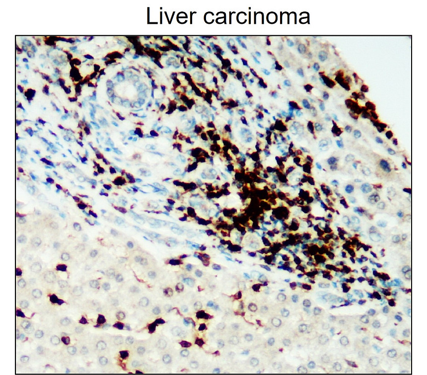 IR77-263 anti-CD45 antibody_Liver carcinoma IHC image