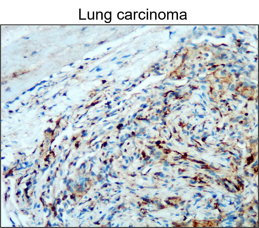 IR77-264 anti- CD45 antibody_Lung carcinoma IHC image