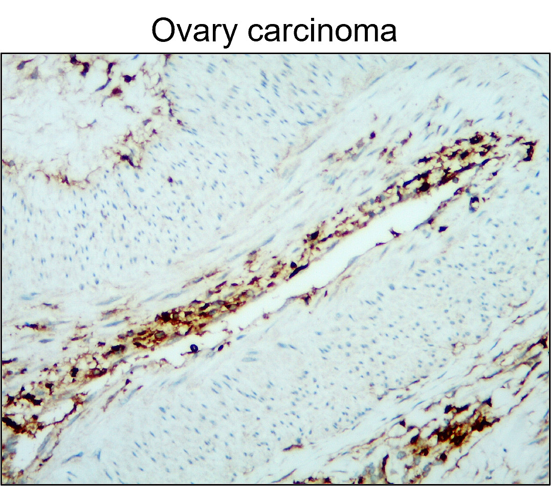 IR77-264 anti- CD45 antibody_Ovary carcinoma IHC image