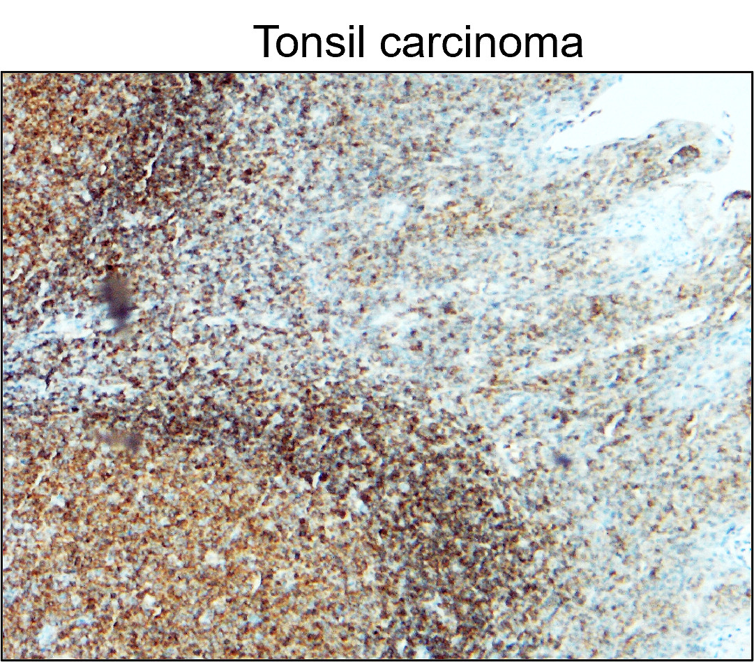 IR77-264 anti- CD45 antibody_Tonsil carcinoma IHC image