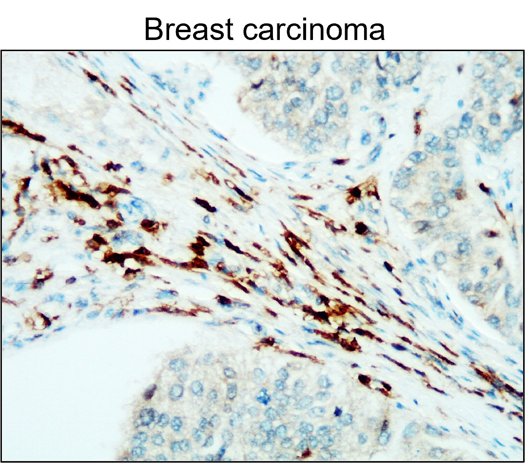 IR77-264 anti- CD45 antibody_Breast carcinoma IHC image