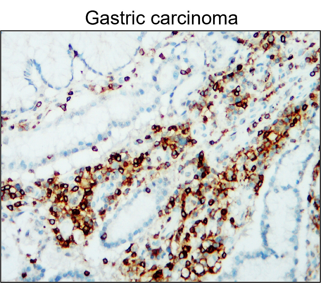 IR77-264 anti- CD45 antibody_Gastric carcinoma IHC image