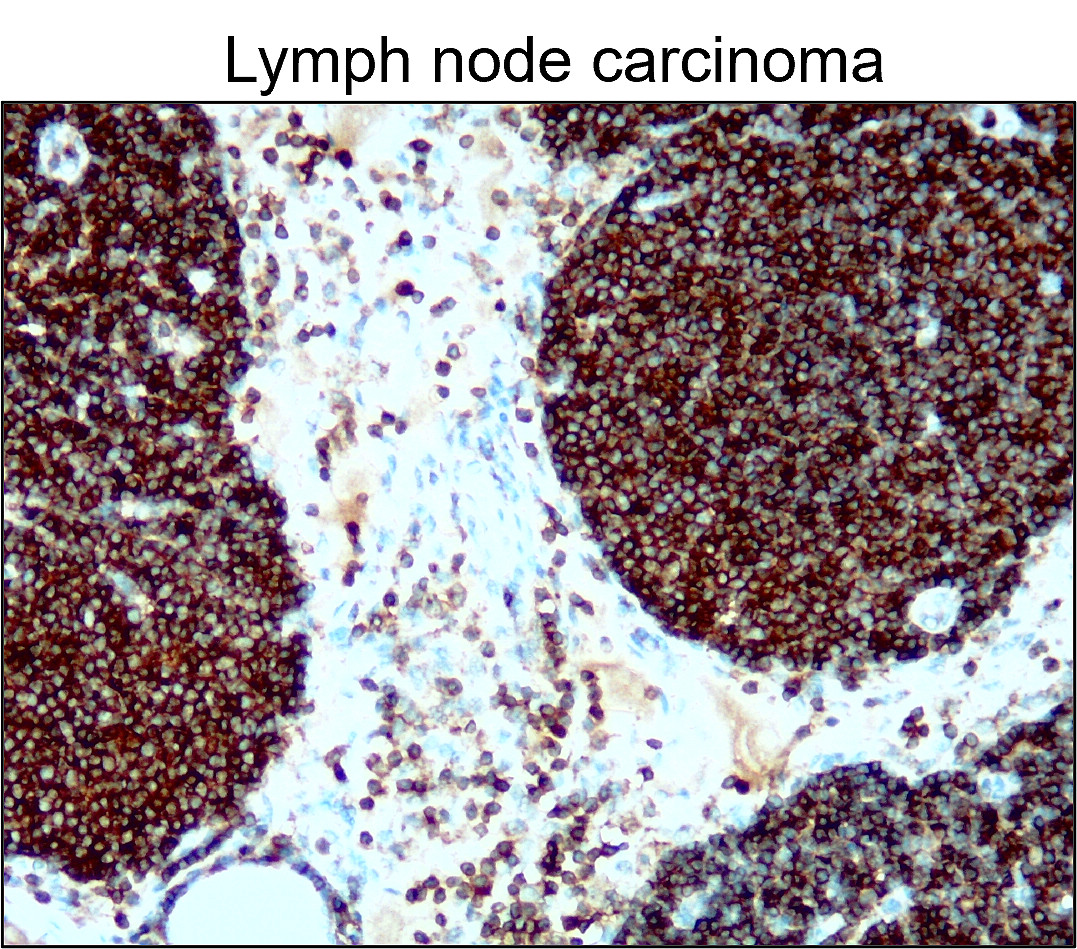 IR77-264 anti- CD45 antibody_Lymph node carcinoma IHC image