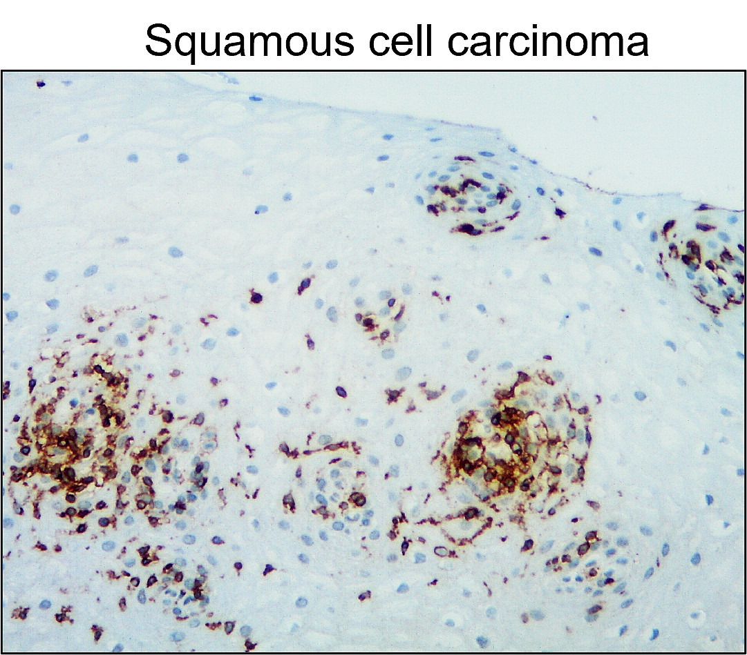 IR77-264 anti- CD45 antibody_Squamous cell carcinoma IHC image