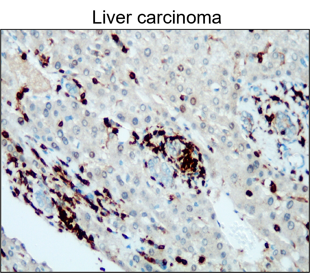 IR77-264 anti- CD45 antibody_Liver carcinoma IHC image