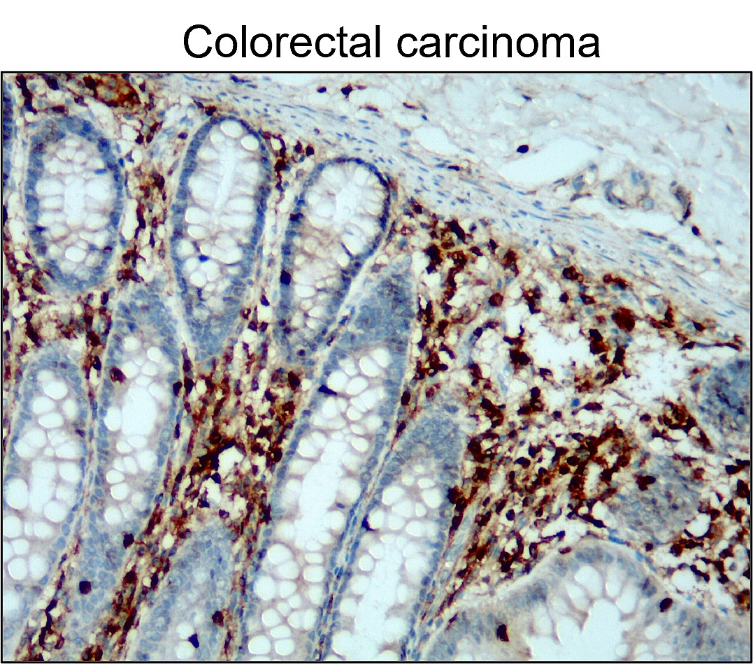 IR77-264 anti- CD45 antibody_Colorectal carcinoma IHC image