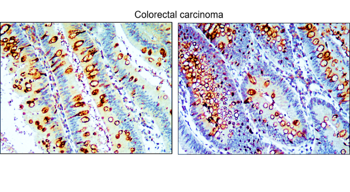 IR91-384 anti-SQSTM1 / p62 antibody_Colorectal carcinoma IHC image