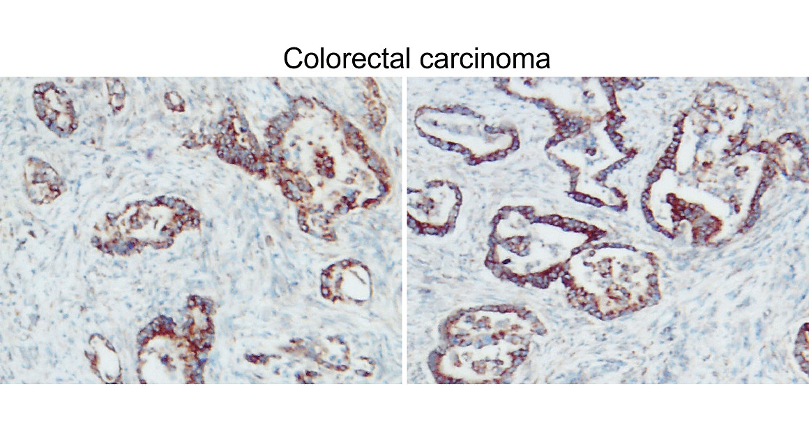 IR93-389 anti-BAX antibody_Colorectal carcinoma IHC image All lanes
