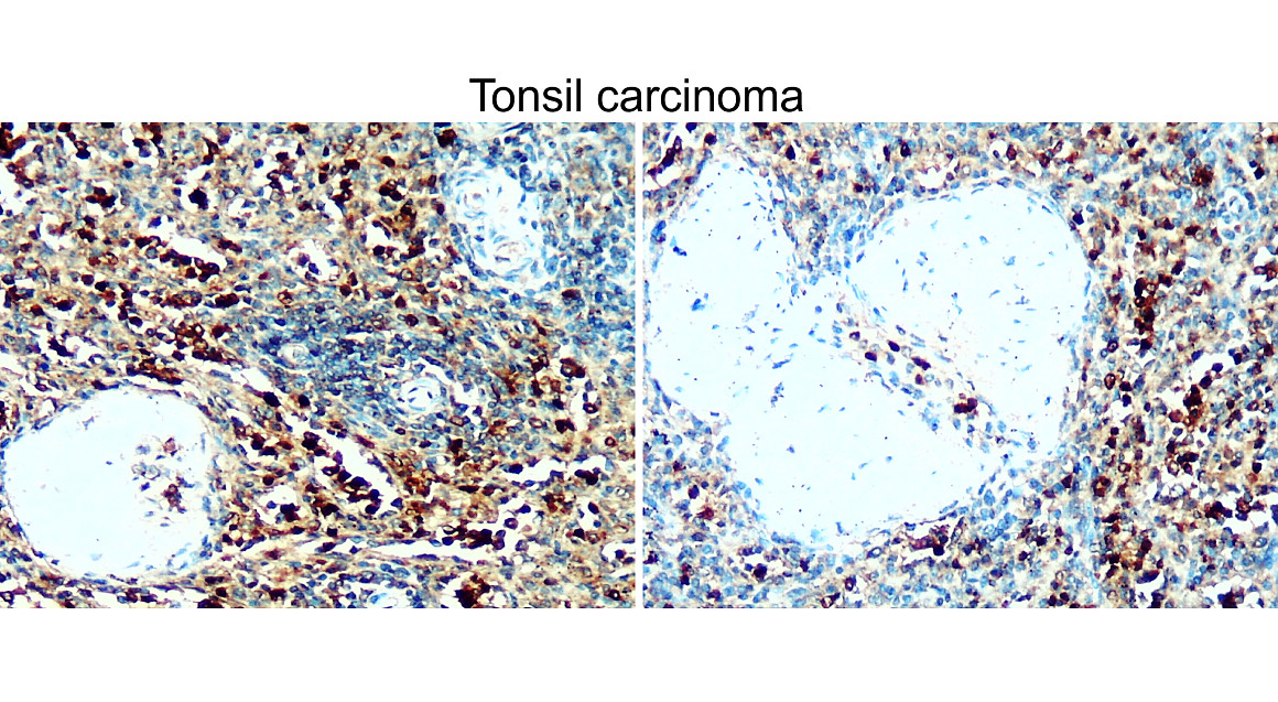 IR93-389 anti-BAX antibody_Tonsil carcinoma IHC image All lanes
