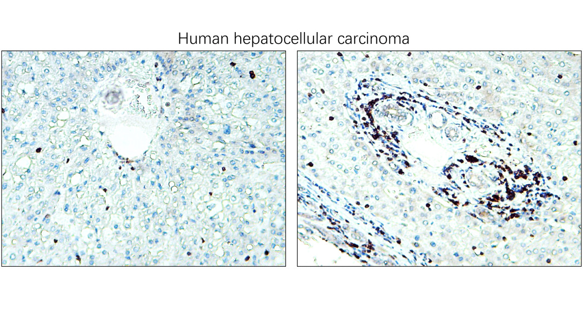 IR252-1 anti-CD3 antibody_Hepatocellular carcinoma IHC image