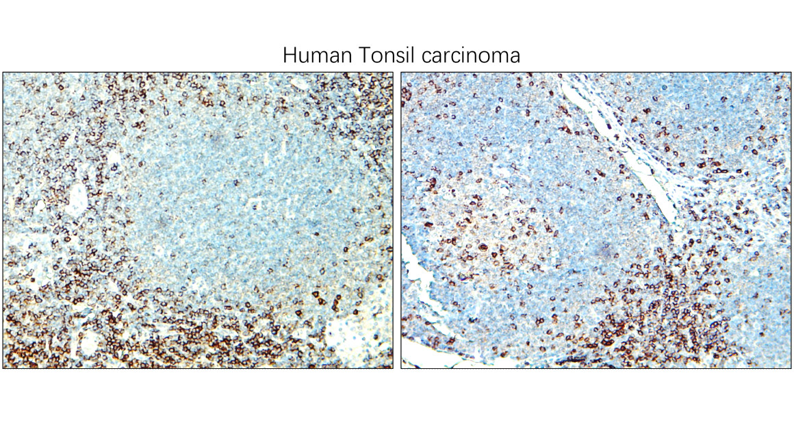 IR252-1 anti-CD3 antibody_Tonsil carcinoma IHC image