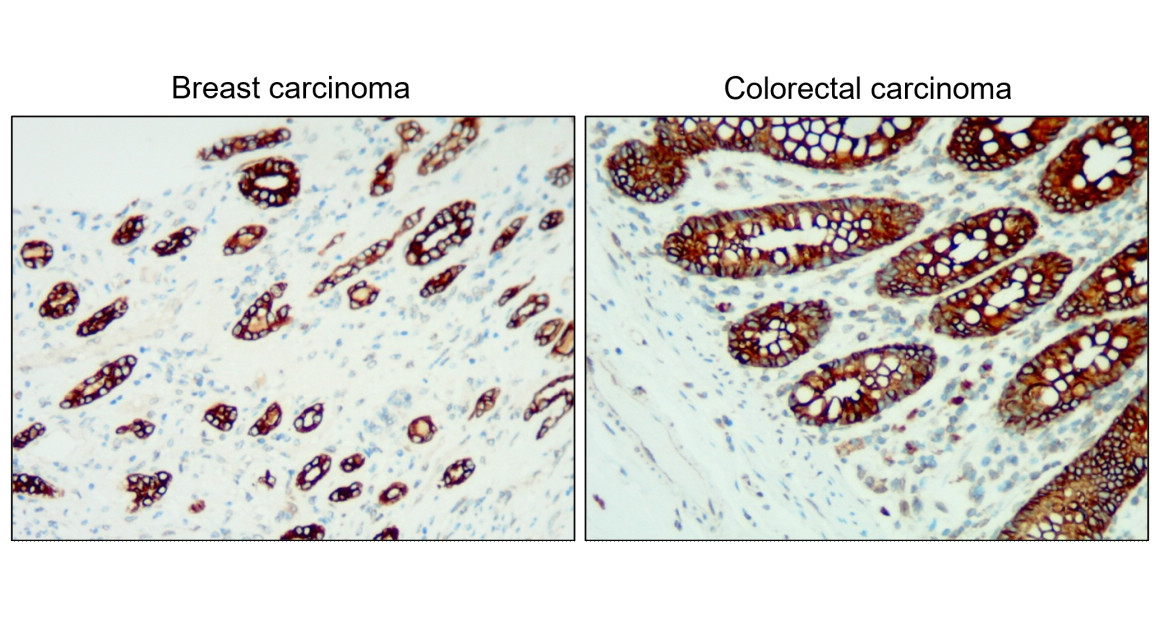 IR236-890 anti-Cytokeratin 18/19 antibody IHC image IR236-890 anti-Cytokeratin 18/19 antibody IHC image